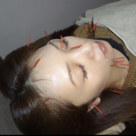 アリス鍼灸整骨院 美容鍼（スタンダードコース）のメニュー画像