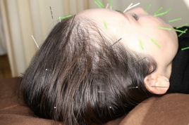 はりきゅう筋膜リリース 鍼灸治療院リーチ 育毛鍼のメニュー画像