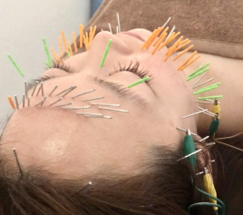 プメハナ鍼灸整骨院 美容鍼100本電気鍼＆ ​美顔小顔指圧のメニュー画像