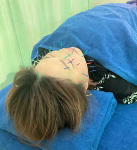 ライフハピネス鍼灸マッサージ院 美容鍼(頭皮鍼＋顔鍼40本~)のメニュー画像