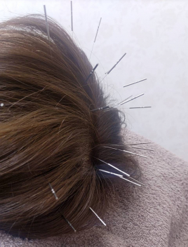 笹岡尚幸鍼灸院 電気頭皮鍼·育毛鍼·美髪鍼 トライアルのメニュー画像