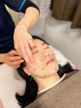 長町ささき鍼灸整骨院 美容鍼　ロングコースのメニュー画像