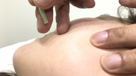 オリーブ鍼灸整骨院 初回美肌審美はり（お顔のみ）のメニュー画像