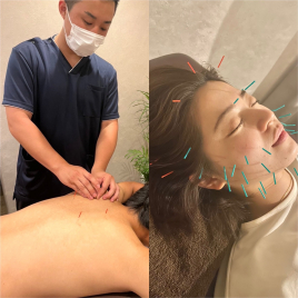 VIBARI 美容鍼+鍼灸治療のメニュー画像
