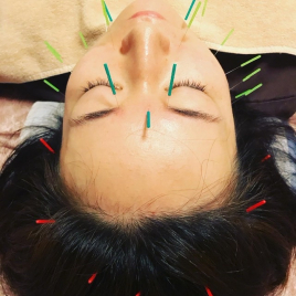 Harimo鍼灸治療院 美容鍼（顔のみコース）のメニュー画像