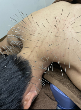 鍼処SHIRAKAWA 浦和院 ルート鍼治療　30分のメニュー画像