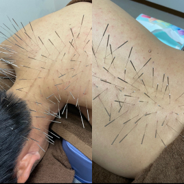 鍼処SHIRAKAWA 浦和院 ルート鍼治療　６０分のメニュー画像