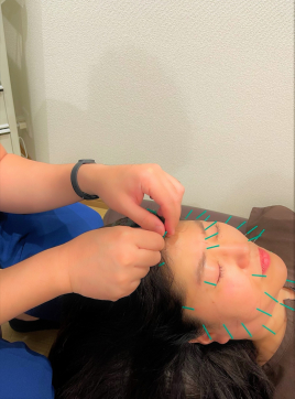 ライジング鍼灸接骨院 ライジング式美容鍼（火・金限定）のメニュー画像