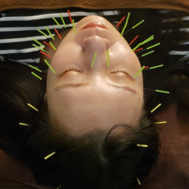 鍼灸サロン 悠雲 【肌の深部からお手入れ】美容鍼のメニュー画像