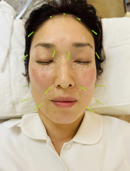 整体・鍼灸サロンAnon 美容鍼(埋金美顔法＋幹細胞上清液＋パルスのメニュー画像