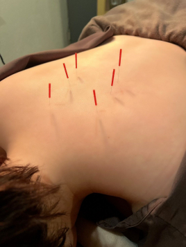 リプラーナ整骨鍼灸院 鍼灸マッサージのメニュー画像