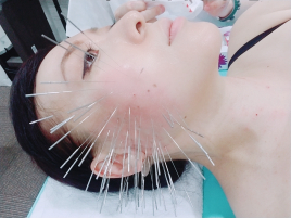 THE CRANN　はりきゅう院 鬼美容鍼・ルート治療の顔の鍼のメニュー画像