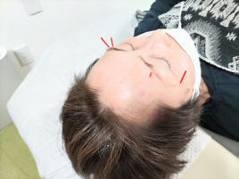 まるめ鍼灸治療院 オプションメニューお顔の鍼のメニュー画像