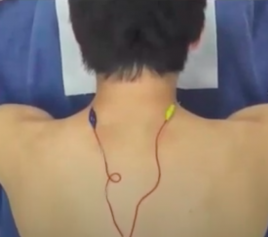 松江はりきゅう治療院（落合・中井・東中野） 鍼治療のメニュー画像