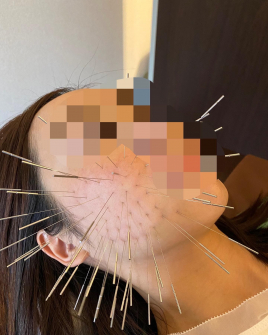 HIRO鍼灸院 (ルート治療専門院) ルート鬼美容鍼　スタンダードのメニュー画像