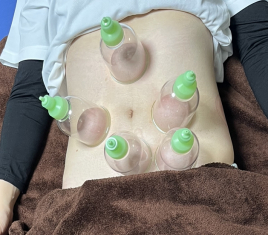 鍼灸 蓮の花 吸玉（カッピング）腸活のメニュー画像