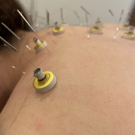 のんこり鍼灸治療院 通常コース(２回目以降)のメニュー画像