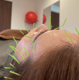 のんこり鍼灸治療院 美容鍼のメニュー画像