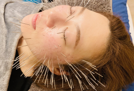 京田辺えーる鍼灸整骨院 はじめての方・美容鍼コースのメニュー画像