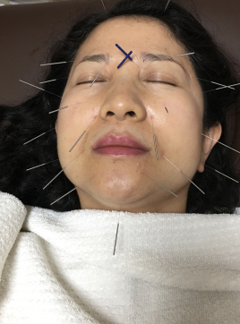 義泉治療院 美容鍼コースのメニュー画像