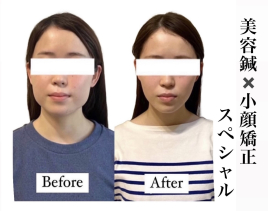 小顔美容鍼灸院 HARIKA 大阪 心斎橋店  No.１☆美容鍼×小顔矯正【スペシャル】のメニュー画像