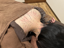 はりきゅう指圧処 うめだや ルート鍼治療〜ショート〜のメニュー画像