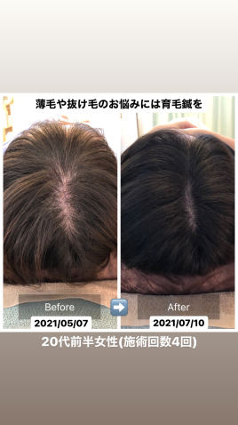 中村鍼灸院広島院 育毛鍼のメニュー画像
