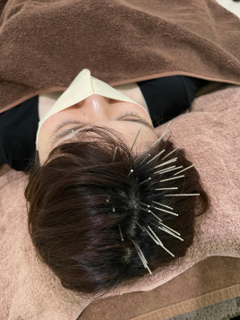 漢方ひがしやま鍼灸サロン 薄毛・抜け毛に　頭皮鍼（全身調整付き）のメニュー画像