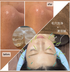 Relama美容鍼✕マッサージ 【ご新規様限定】美容鍼✕ハイドロ毛穴洗浄のメニュー画像