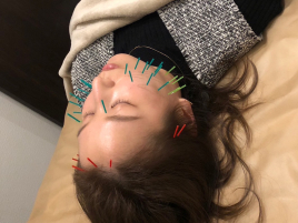 鍼灸院 LEGIT 美容鍼（小顔・美肌・リフトアップ）のメニュー画像