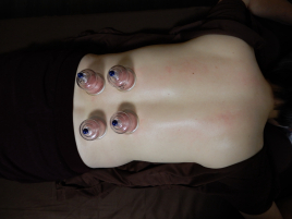 鍼灸　無苦庵 吸玉療法（局所）院内オプションのメニュー画像