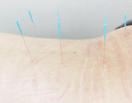 王鍼灸治療院　健康堂 全身鍼灸のメニュー画像