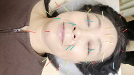 王鍼灸治療院　健康堂 美容鍼のメニュー画像