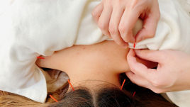 ふな鍼灸整骨院 局所鍼灸のメニュー画像