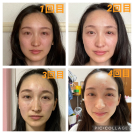ルート鍼灸治療院ほむら ルート治療×鬼美容鍼のメニュー画像