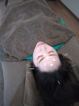 KAGURAOKA鍼灸院 【初】美顔鍼　鍼が初めての方でもおすすめのメニュー画像