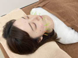 美容整体サロンFeliz 美容鍼　お顔集中コース〈45分〉のメニュー画像