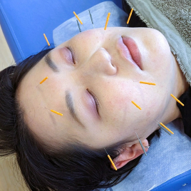 富山ふじい鍼灸整体院 美容鍼のメニュー画像