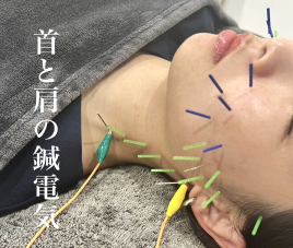 小顔美容鍼灸院 HARIKA 大阪 心斎橋店 【根本から首肩の凝り解消】首と肩の鍼電気のメニュー画像