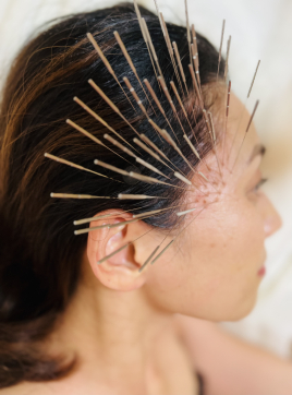 はり治療院ここから【前橋院】 薄毛治療のメニュー画像