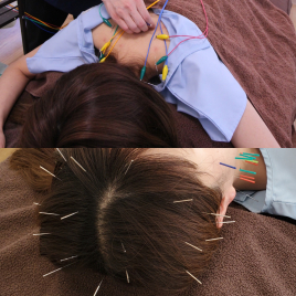 こばやししんきゅう 鍼灸治療 ショート(局所)+頭皮鍼のメニュー画像