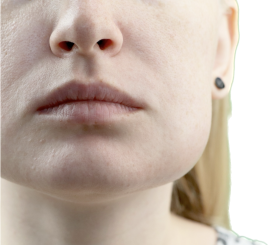 鍼灸CiruelaValle−美容鍼・小顔− 【初回】『エラ張り撃退美容鍼』のメニュー画像