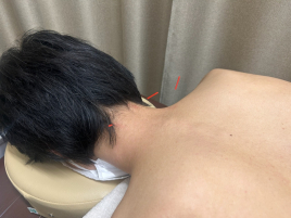 亀田名倉堂鍼灸接骨院 鍼（局所）のメニュー画像