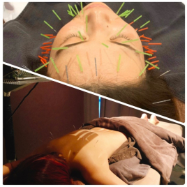 美容鍼　ledia（ルディア）堂島店 お顔と頭皮+お身体のオーダーメイド鍼のメニュー画像