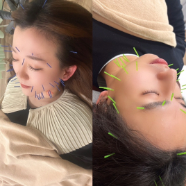 harisuru  神戸訪問鍼灸付属治療院 お顔スッキリ美容鍼コースのメニュー画像