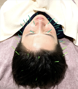 鍼灸サロンZouzou(ずず)  【メンズ】New!男性専用スカルプ美顔鍼のメニュー画像