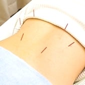 iCure鍼灸接骨院　イオンスタイル品川シーサイド 鍼治療のメニュー画像