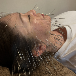 アディオ鍼灸カイロプラクティック ルート美容鍼のメニュー画像