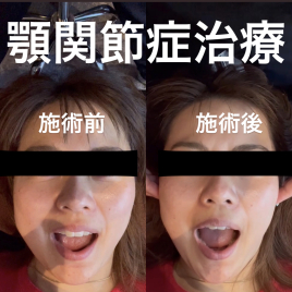 顎関節症・美容鍼専門　つばさ鍼灸院 顎関節症治療（4回目以降）のメニュー画像