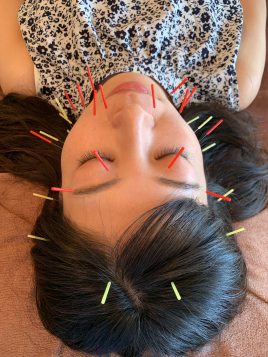 細胞美容サロンCB 美容鍼のメニュー画像